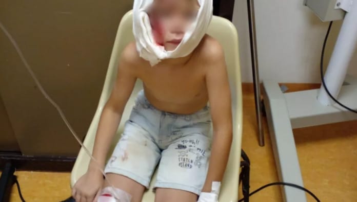 Rottweiler atacó a un niño y le desfiguró el rostro